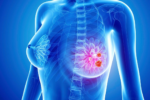 Multidisciplinary Care for Improving Breast Cancer Outcomes